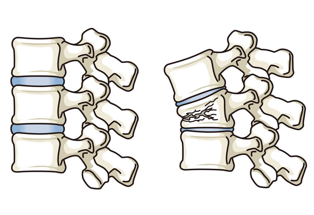 vertebral compression fractures