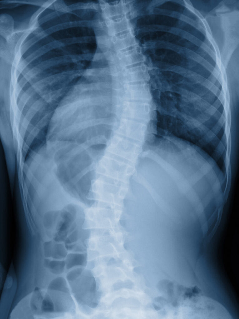 Scoliosis curve on x-ray